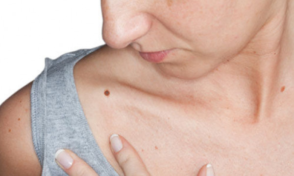 كيف نميز الشامة العادية عن الخبيثة؟