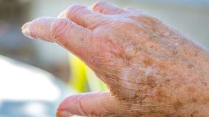 بقع بنية على الجلد.. قد تنذر بالأسوأ