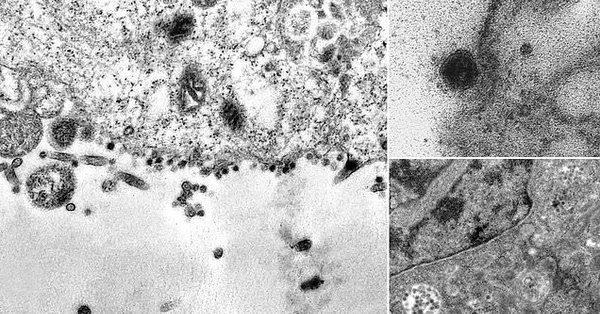 لأول مرة.. التقاط لحظة إصابة فيروس كورونا لخلية سليمة (صور)