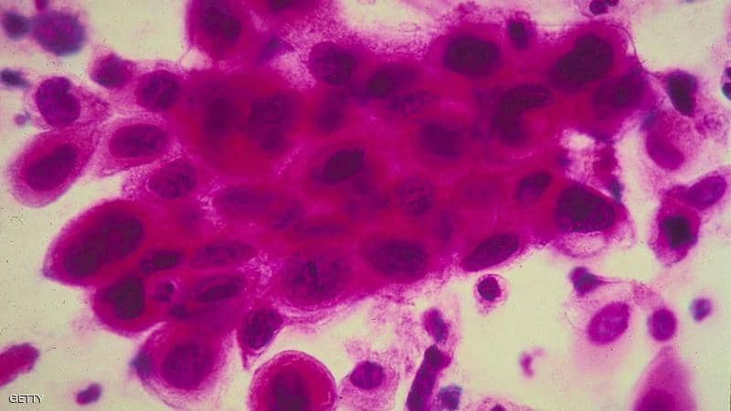 اختراق تاريخي.. تقنية جديدة تنجح في قتل الخلايا السرطانية
