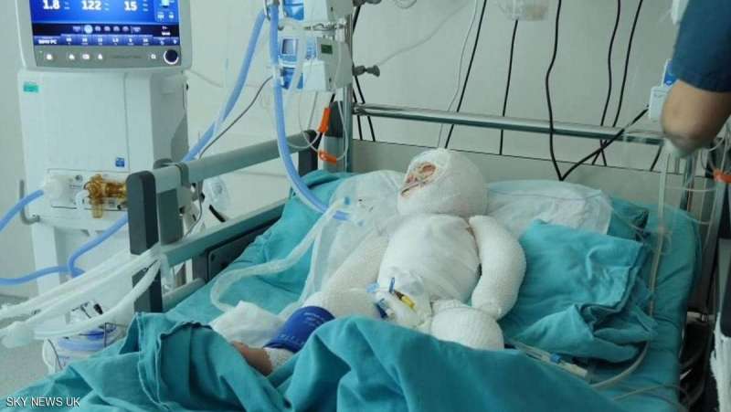 طفلة سورية تفطر القلوب.. نزحت 7 مرات ثم احترقت في مخيم للنازحين في إدلب