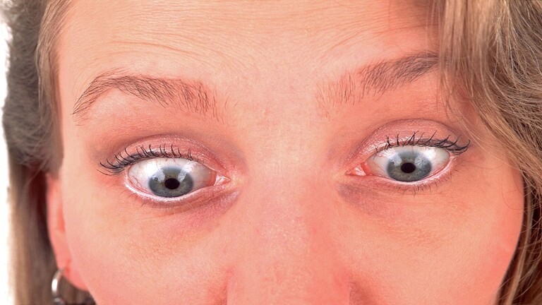 ما أسباب ظهور الدوائر الزرقاء تحت العينين؟