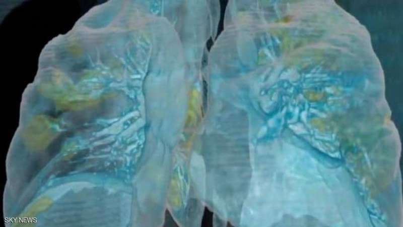 شاب يفقد رئتيه تماما بسبب كورونا.. وهذا ما فعله الأطباء