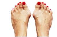 طبيب يوضح سبب تورم إبهام القدم