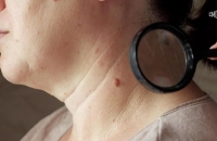 الشامات المريبة.. العلامات التحذيرية وأخطر الأماكن على الجسم