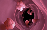 تحذير جديد.. الأطعمة فائقة المعالجة تعزز نمو الزوائد المعوية الممهّدة للسرطان