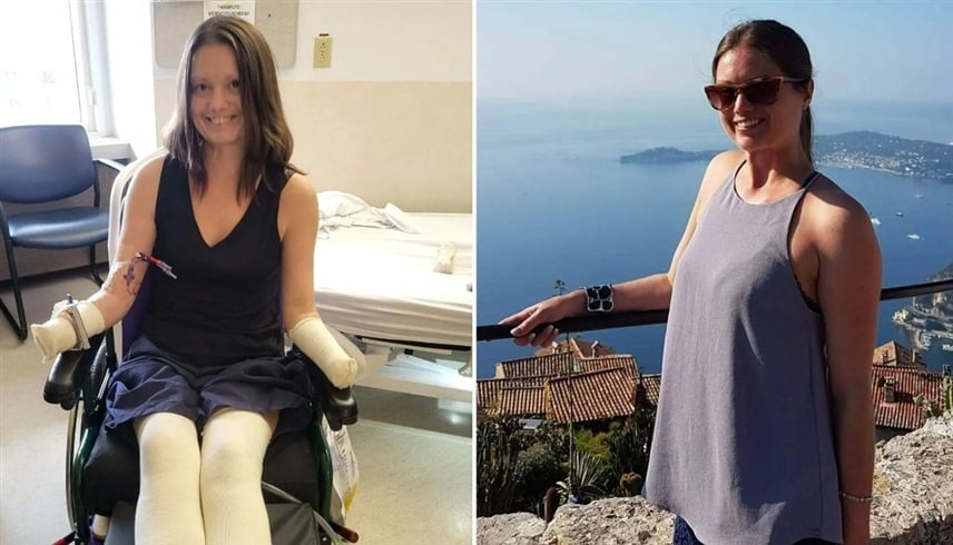 آلام بسيطة في الفك تنتهي ببتر يدي وقدمي فتاة بشكل مأساوي