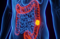 زياة صلابة القولون ودورها في تطور السرطان