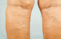 طريقة للوقاية من تطور الدوالي