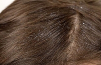 قشرة الرأس وأسبابها المتنوعة وكيفية التعامل معها بفعالية