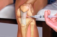 دواء مبتكر يجعل الغضروف يبني نفسه من جديد!