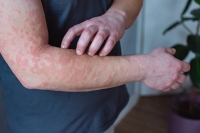 جفاف الجلد: متى يكون عرضا صحيا خطيرا