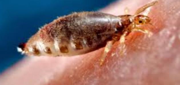 طرق فعالة لعلاج قمل الجسم