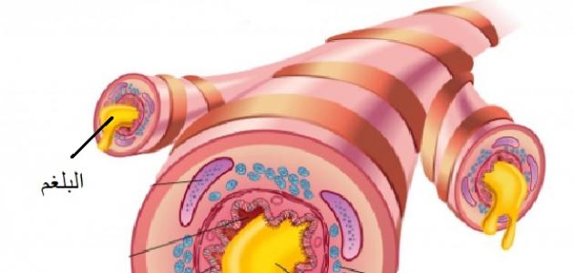 البلغم: تعريفه وأسبابه وعوامل خطره