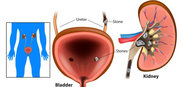 أعراض حصوة الحالب وأسبابها وطرق تشخيصها