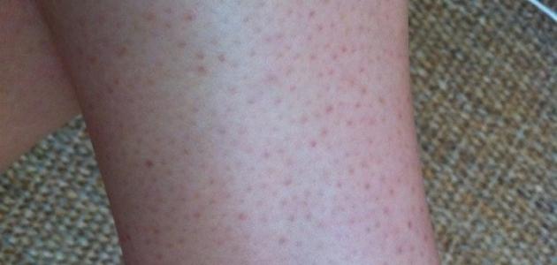 أسباب وطرق إزالة النقط السوداء من الساقين