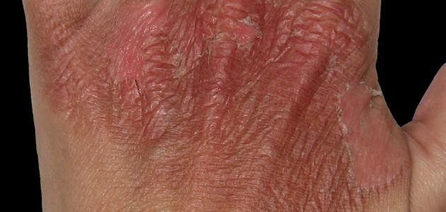 حروق الدرجة الثانية: الأعراض، الأسباب، والعلاج