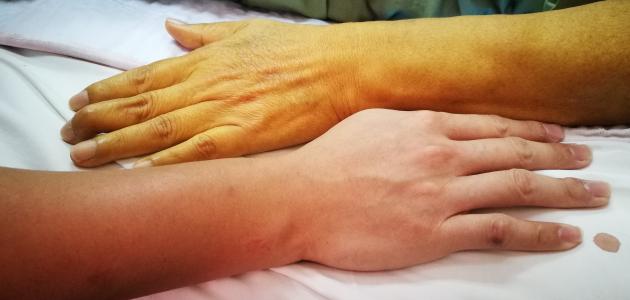 أسباب ظهور اليرقان وبقع صفراء على الجلد