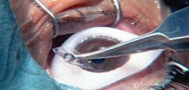 نصائح هامة بعد عملية الليزك