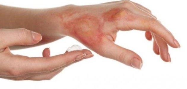 آثار الحروق وطرق علاجها