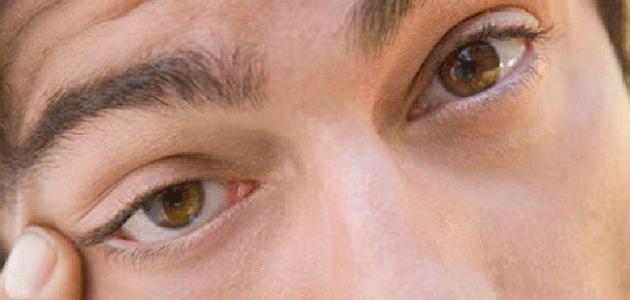 نصائح للتخلص من رفة العين