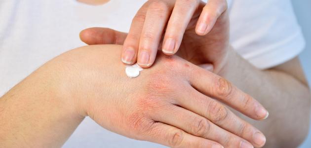 خيارات علاج حساسية اليدين