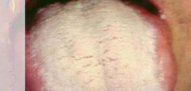 فطريات الفم عند الأطفال: الأسباب والأعراض وطرق العلاج