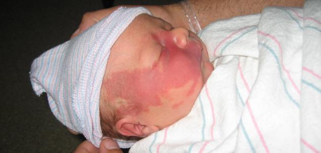 أسباب وعلاج نقص الصفائح الدموية عند المواليد