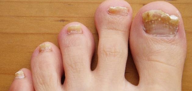 طرق طبيعية لعلاج فطريات الأظافر بفعالية