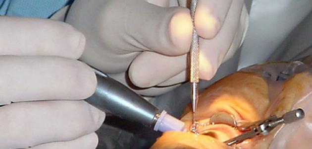 أسباب وعلاج الماء الأبيض في العين