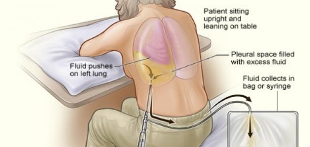 مرض ذات الجنب: الأعراض والأسباب والعلاج