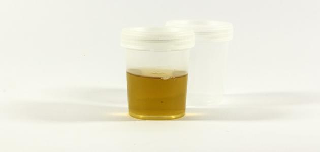 التهاب البول: الأعراض، التشخيص والعلاج