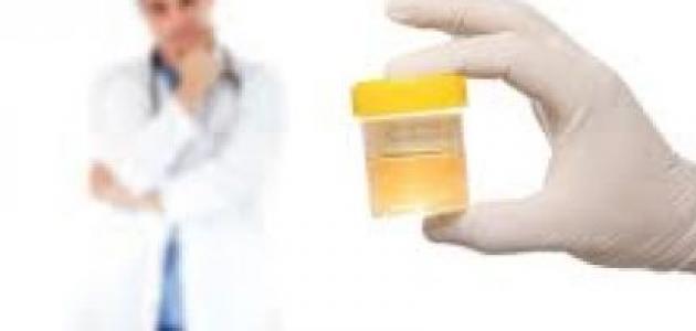 أسباب حرقان البول وطرق التشخيص والعلاج