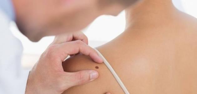 ما هي الشامات ولماذا تظهر