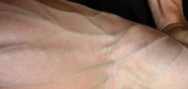 الأوردة البارزة في اليد: تحليل شامل للأسباب، المخاطر، والحلول المستقبلية (2026)