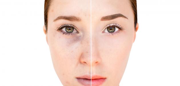 علاج تصبغات الوجه: الأسباب والطرق الفعالة