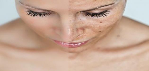 كيفية إزالة الكلف: الأسباب والعلاجات المتاحة