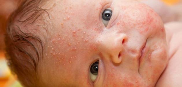 حبوب وجه الرضيع: بين قلق الأمهات وحلول 2026