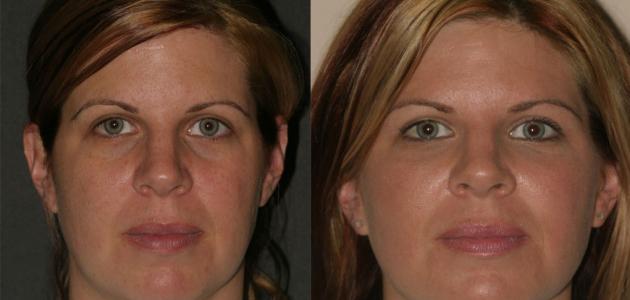 طرق فعالة لحرق دهون الوجه