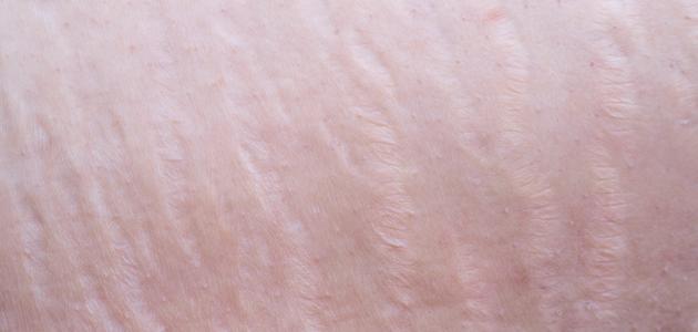 الدليل الشامل للتخلص من تشققات الحمل: حلول 2026