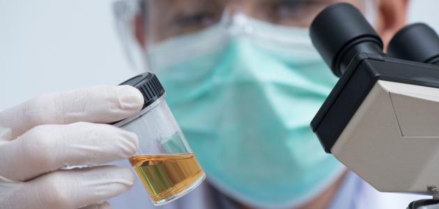 كل ما تود معرفته عن تركيب البول ومكوناته بالتفصيل