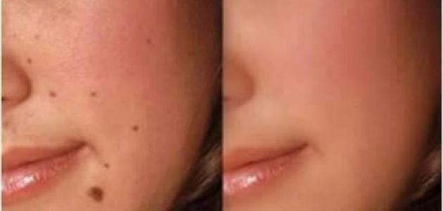 طرق إزالة الشامات من الوجه: الطبية والطبيعية