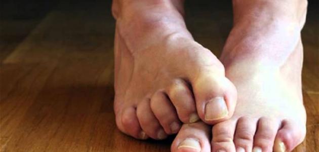 أعراض نقص المغنيسيوم والبوتاسيوم: الأسباب والعلاج