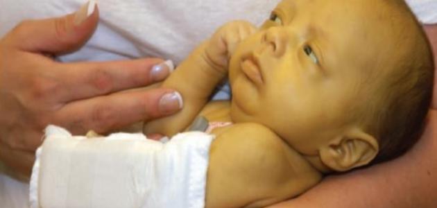 الدليل الشامل لعلاج الصفار عند حديثي الولادة 2026: الأسباب، الأعراض، وأحدث طرق العلاج