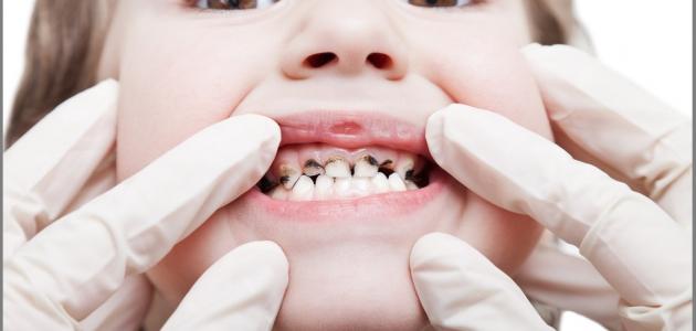 تحليل شامل: علاج تسوس الأسنان واستراتيجيات الوقاية الفعالة