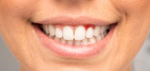 لثة صحية في 2026: روتينك اليومي لوقف النزيف