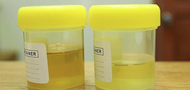 أسباب صديد البول وطرق العلاج