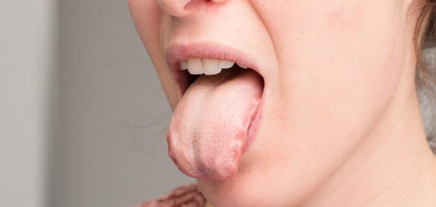 دلالة ألوان اللسان وأسباب تغيرها