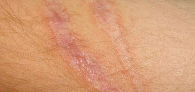 آثار الحروق البنية وطرق علاجها الطبيعية