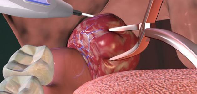عملية استئصال اللوزتين: الإجراءات والمخاطر